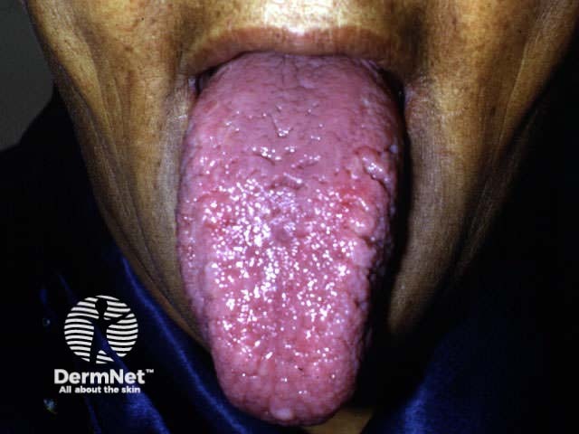 Macroglossia