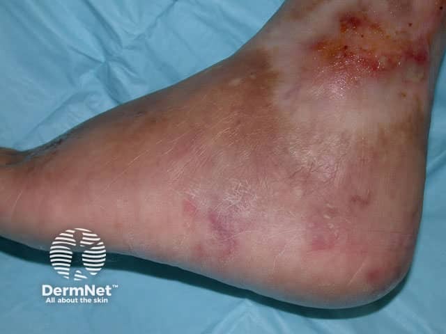 Polyarteritis nodosa