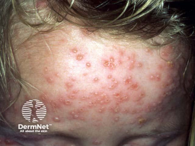 Close-up of vesicles