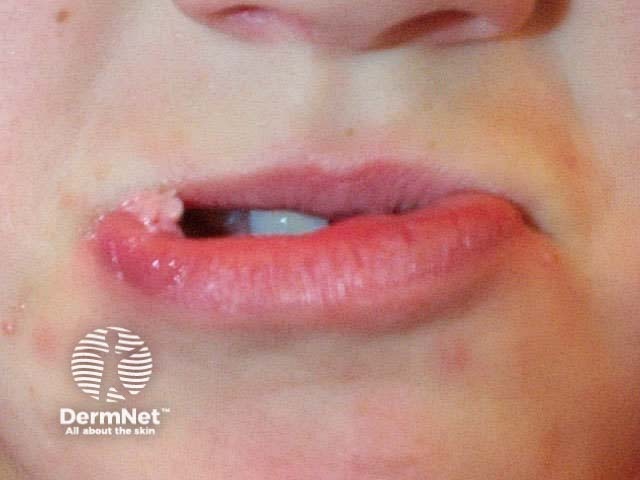 wart on lip type warts on type warts on wart on lip type warts on type warts on