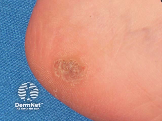 Palmar myrmecia
