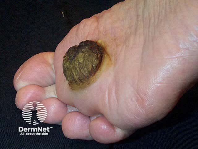 Verrucous carcinoma