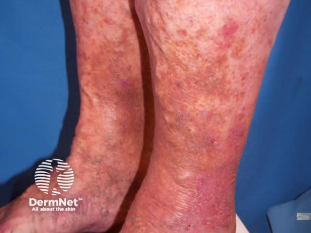 Pigmentation due to venous insufficiency