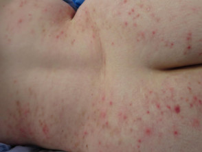 Folliculitis in Down syndrome