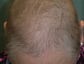 Drug-induced alopecia