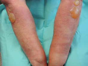 Fig dermatitis