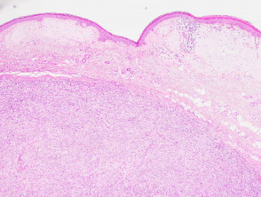 Inflammatory Myofibroblastic Tumour Pathology