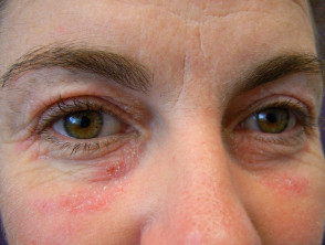 Contact eczema allergic
