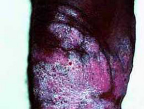 Chromoblastomycosis