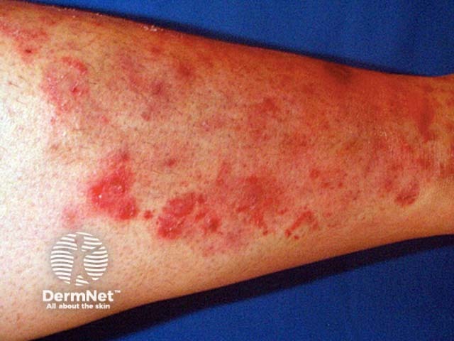 Tinea incognito due to application of topical steroid to fungal infection