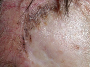 Recurrent basal cell carcinoma