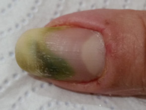 Green nail due to pseudomonas infection with paronychia