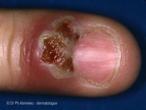 Herpes simplex paronychia