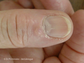 Pseudomyxoid cyst of nail