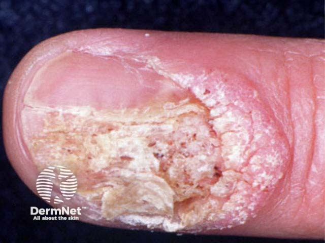 Ungueal wart