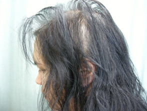 Anagen effluvium: alopecia areata