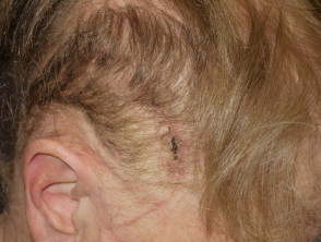 Anagen effluvium due to cranial irradiation