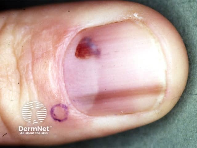 Melanocytic naevus on nail