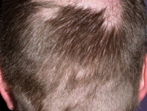 Alopecia from drugs