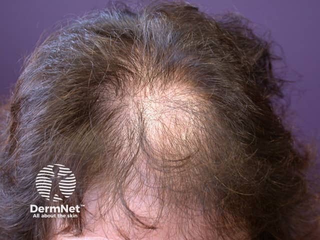 Female balding