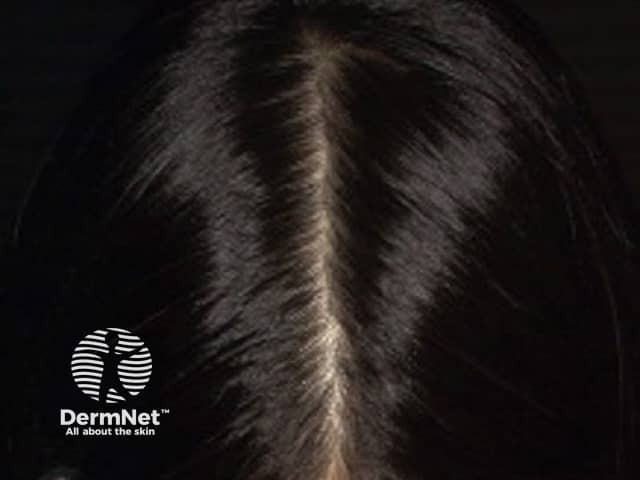Female pattern hair loss