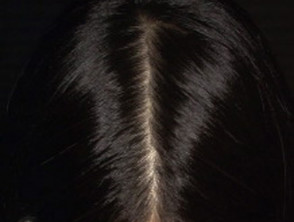 Female pattern hair loss