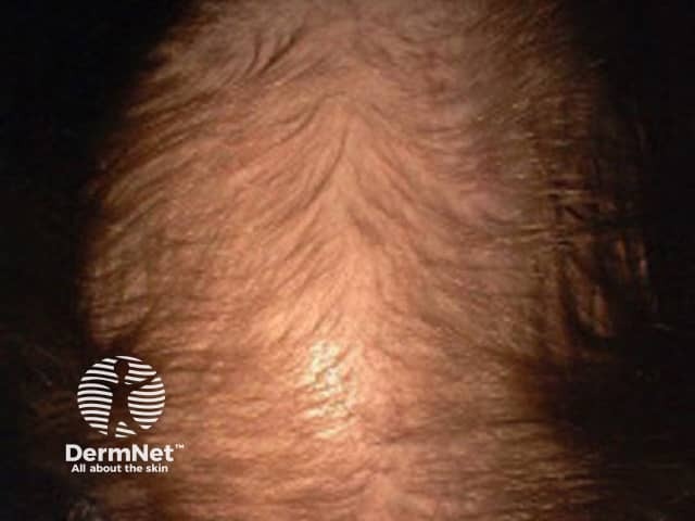 Female pattern hair loss