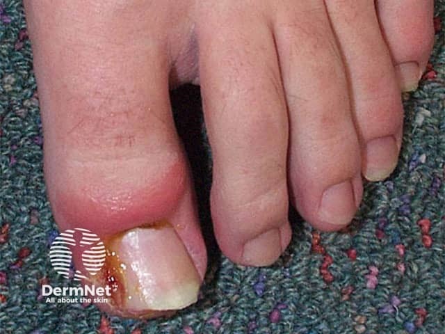 Ingrown nail