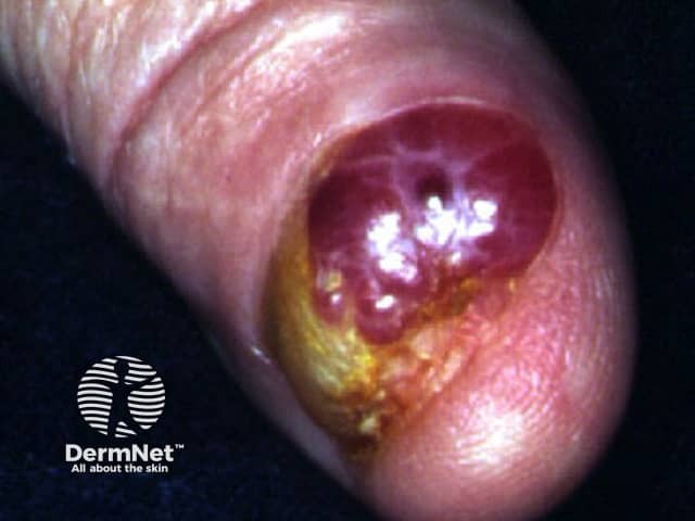 Nail melanoma