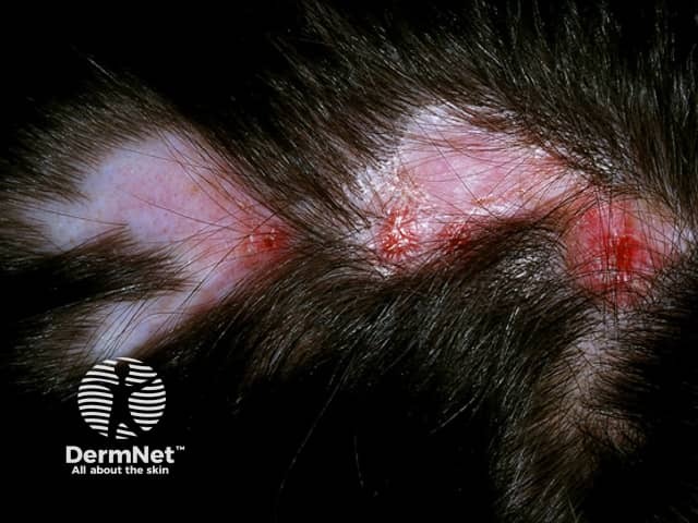 Discoid lupus