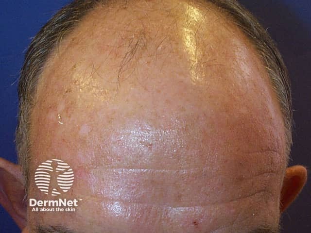 Male balding