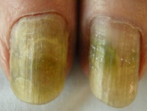 nail pigment5 s
