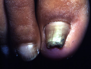 Pincer nail deformity