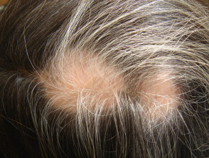 Poliosis in alopecia areata