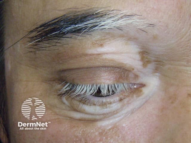 Poliosis in vitiligo