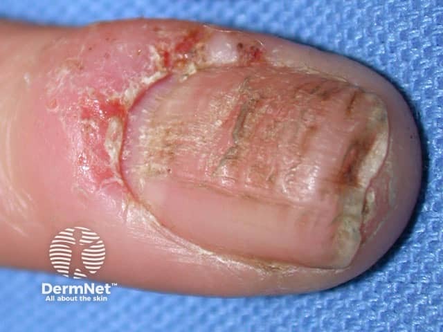 Ridges In Fingernails Symptoms Causes And Treatments