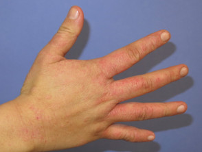 Housewife hand dermatitis