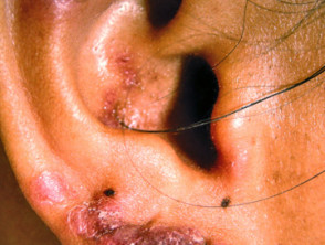 Chronic discoid lupus erythematosus