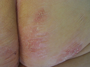 Extragenital lichen sclerosus