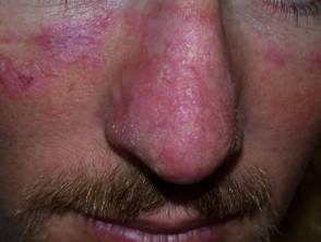 Cutaneous lupus erythematosus 