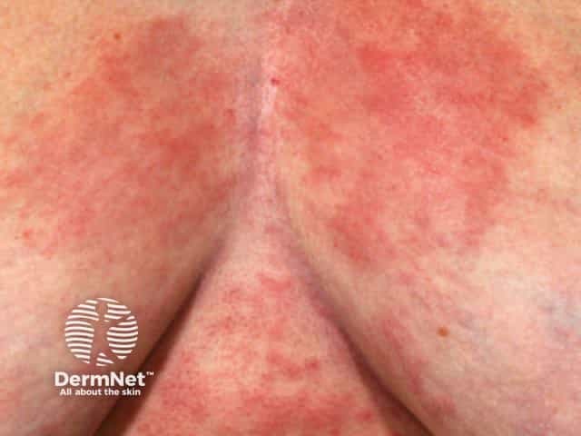 Reticulate erythematous mucinosis