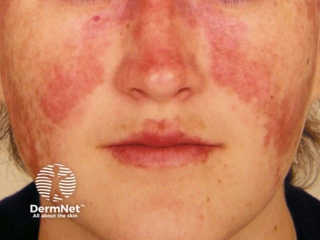 Systemic lupus erythematosus
