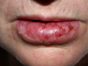 Discoid lupus erythematosus on lip