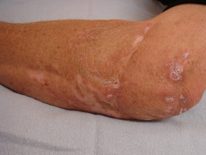 Granulomas in a patient with common variable immunodeficiency