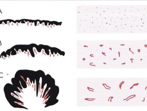Dermatoscopic vascular patterns related to histopathology. From Kittler H et al