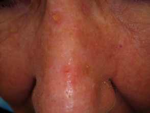 Actinic Keratoses affecting the face