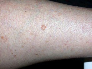 Actinic keratoses affecting the legs and feet 