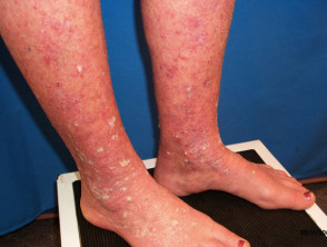 Actinic keratoses affecting the legs and feet 