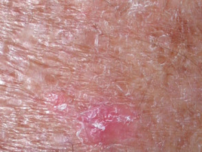 Actinic Keratoses affecting the legs and feet