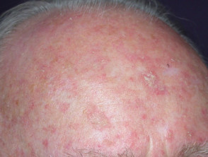 Actinic keratoses affecting the scalp